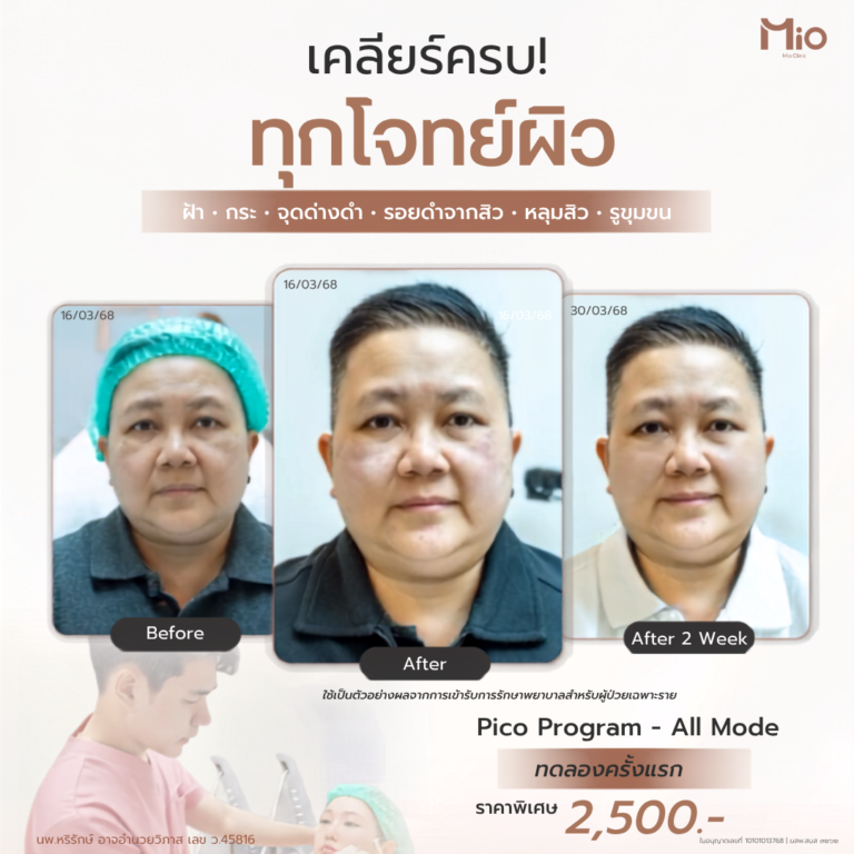 mio clinic pico laser all mode review first trial 2500 fb 1080x1080 1