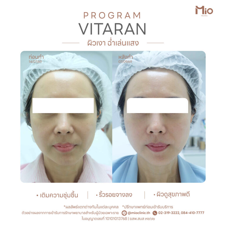 mio clinic vitaran review skin quality before after facebook