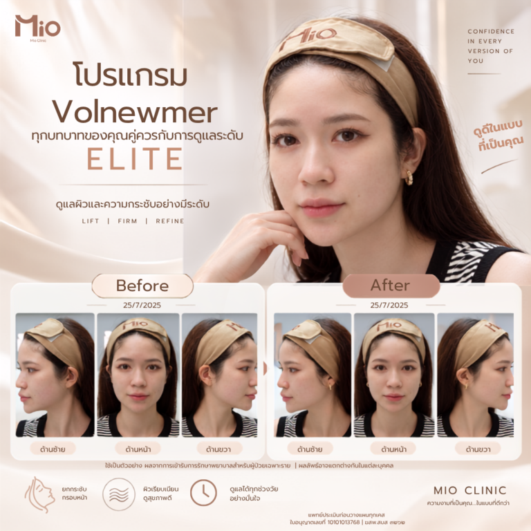 mio clinic volnewmer review before after face firming facebook
